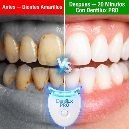 Dentilux PRO — Blanquea Tus Dientes 5 Tonos Más en Solo 20 Minutos Desde Casa ✨